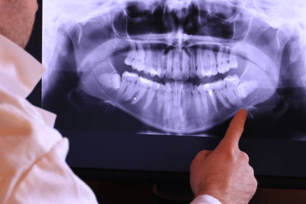 Best Emergency Wisdom Tooth Extraction in Vista, CA